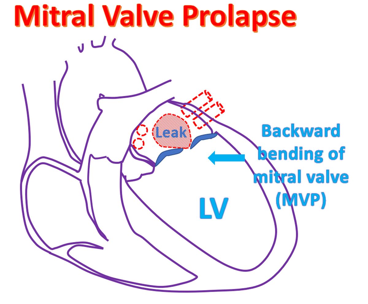 What is mitral valve prolapse (MVP)? - All About Heart And Blood Vessels