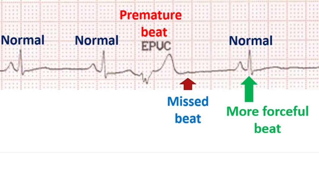 What causes missed beats? – All About Heart And Blood Vessels