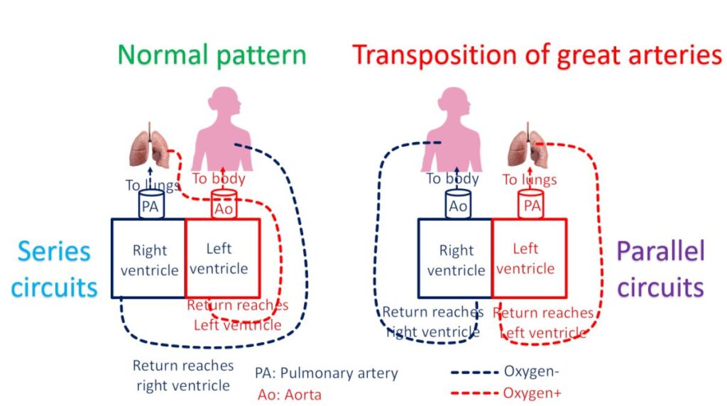 Parallel blood flow circuits in transposition of great arteries