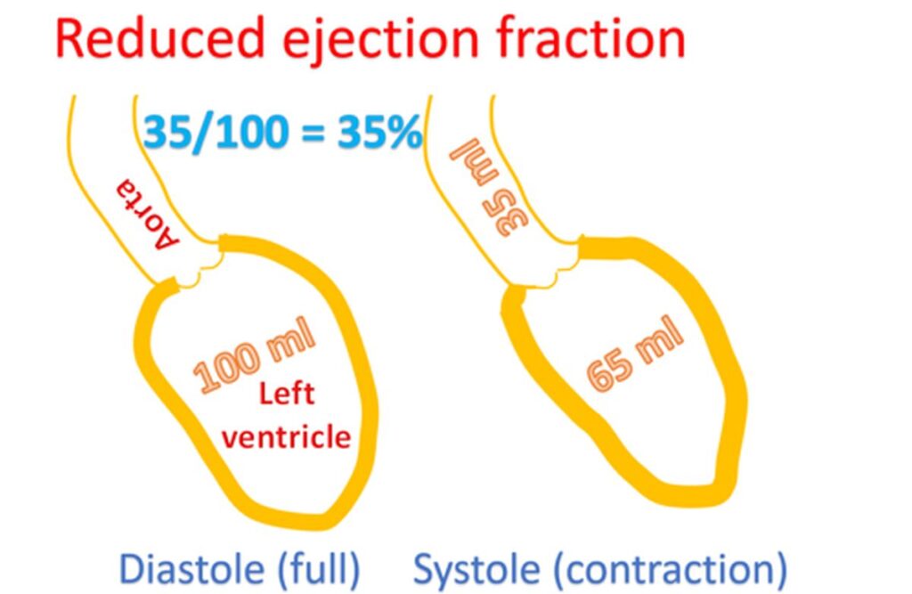 what-is-heart-failure-with-reduced-ejection-fraction-all-about-heart