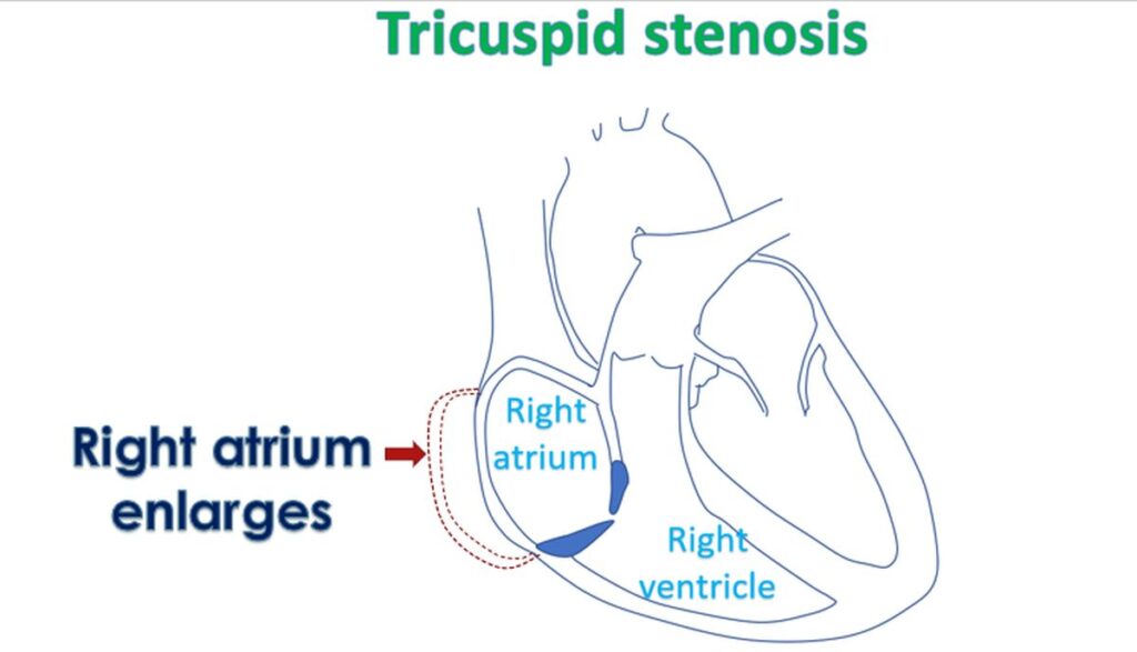 Right atrium enlarges in tricuspid stenosis