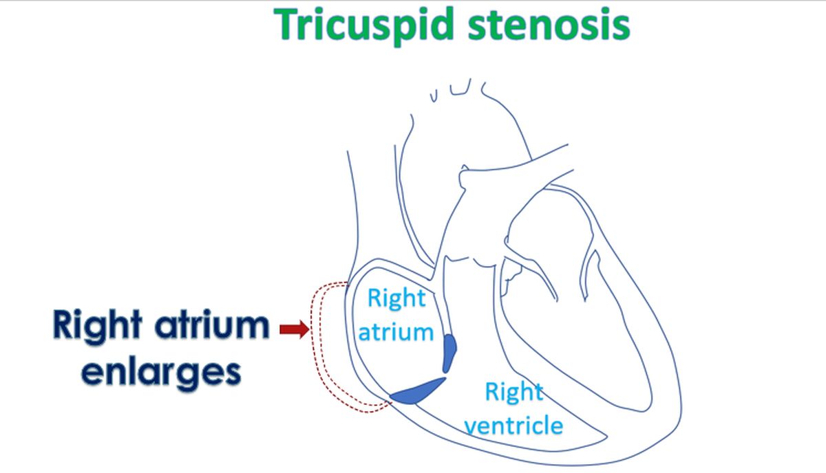 What Is Tricuspid Stenosis? – All About Heart And Blood Vessels