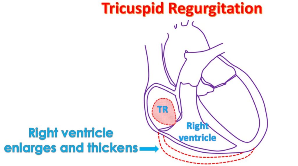 Right ventricle enlarges and thickens