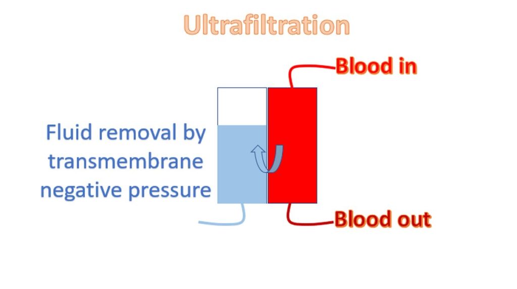 Schematic diagram of ultrafiltration to remove excess fluid