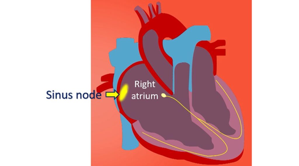 Sinus node (Natural pacemaker of heart)