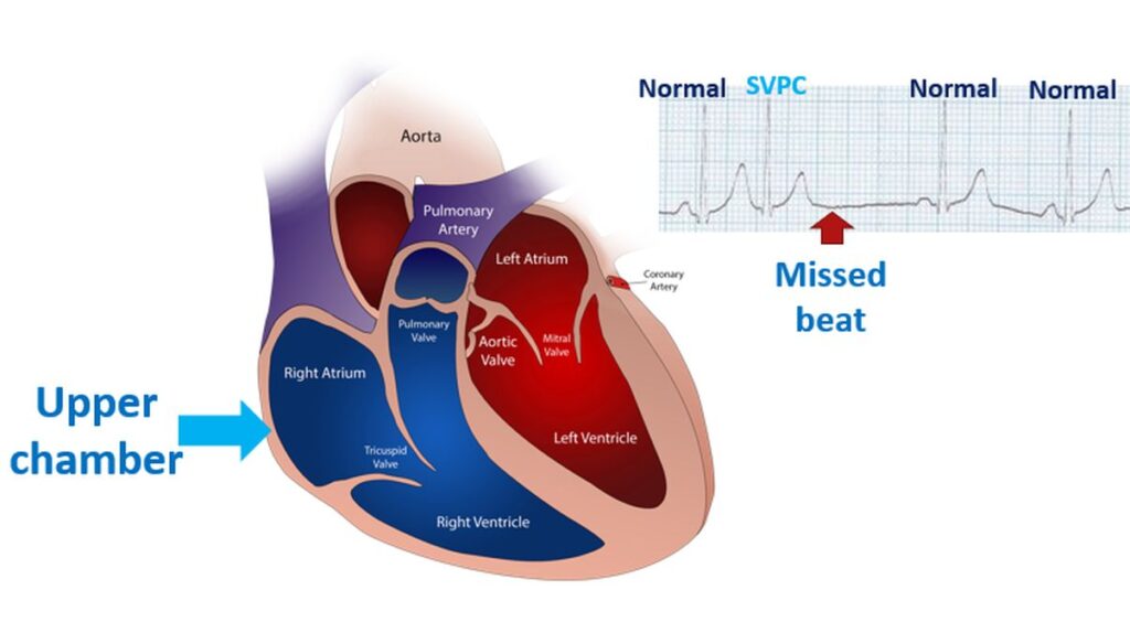 Supraventricular ectopic beat