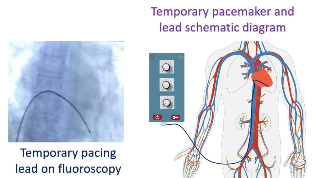 Temporary pacemaker and lead schematic diagram