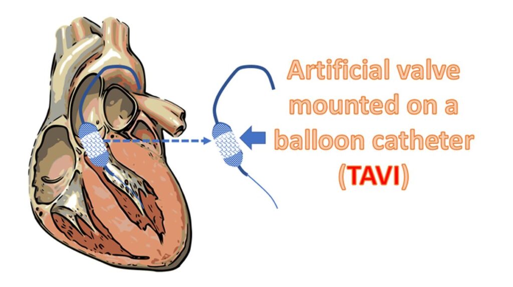 Transcatheter aortic valve implantation (TAVI) - Schematic diagram