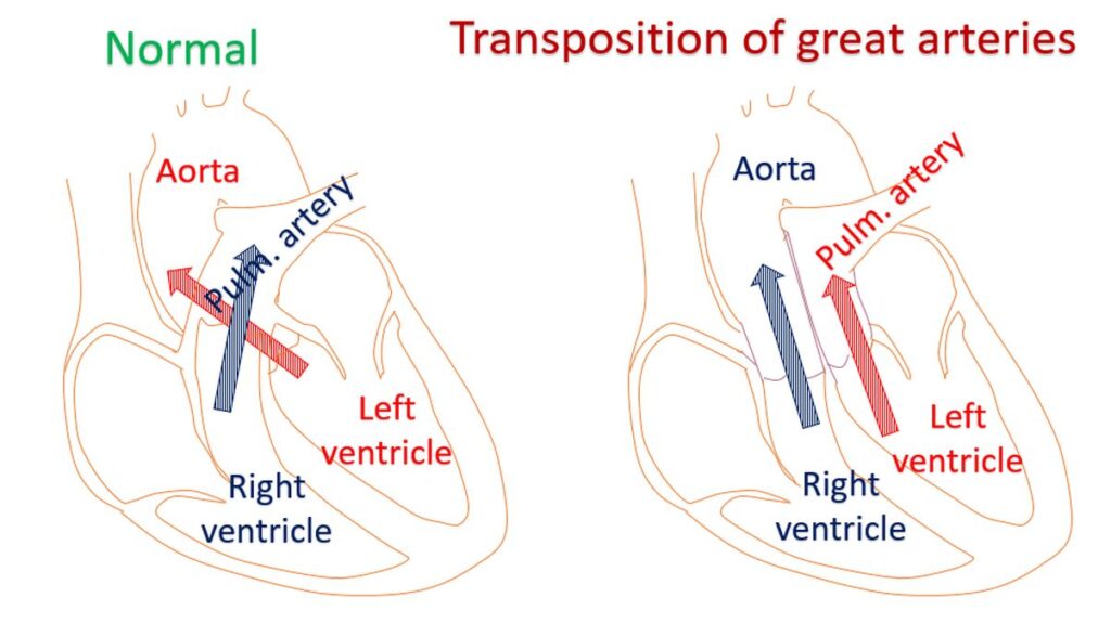 Transposition of great arteries
