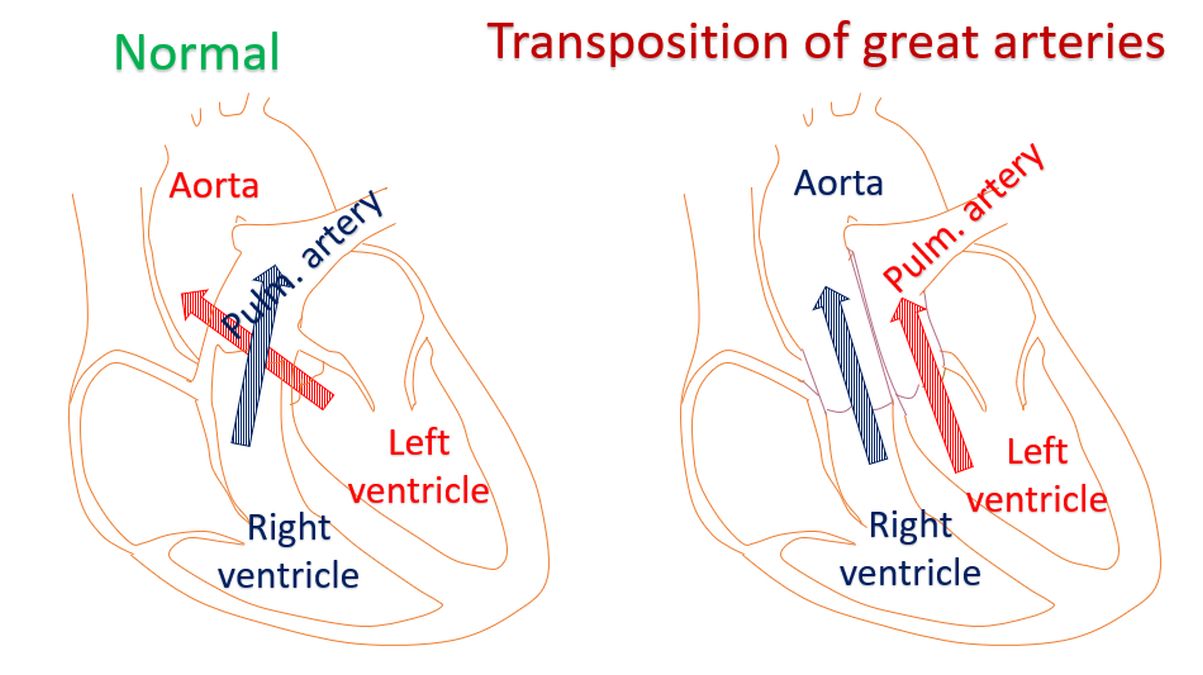 What is transposition of great arteries (TGA)? – All About Heart And ...