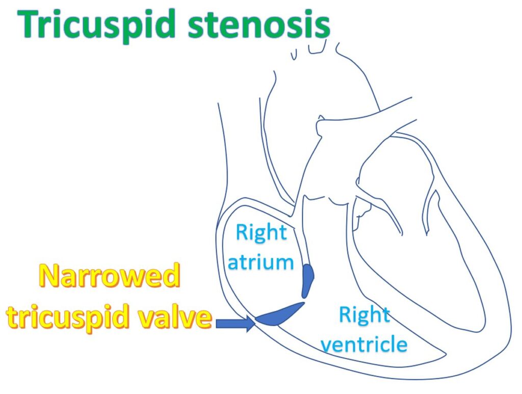 Tricuspid stenosis