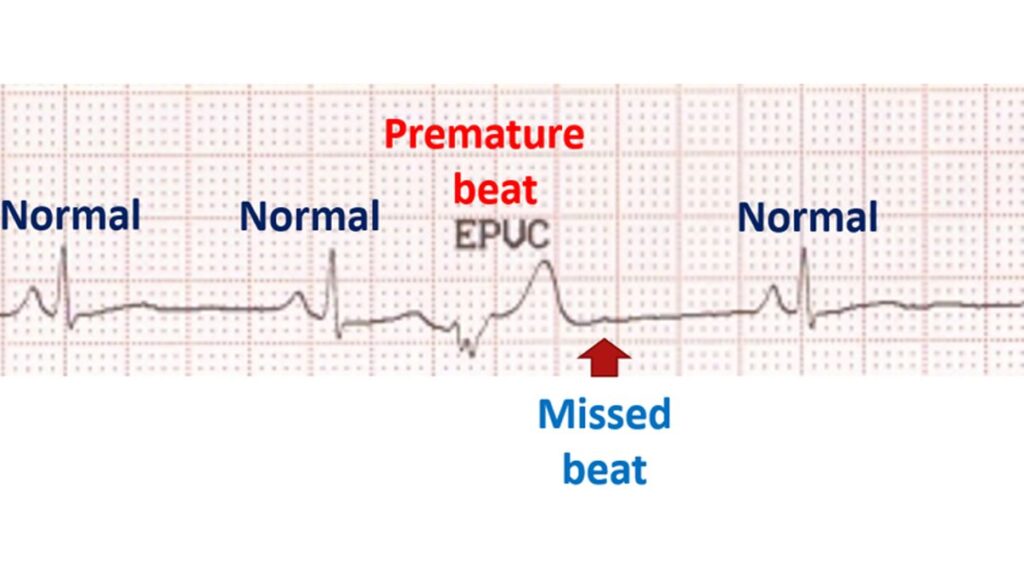 Ventricular premature beat manifesting as missed beat