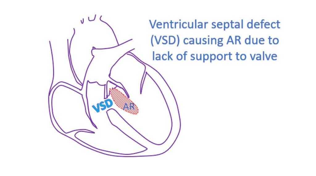 Ventricular septal defect (VSD) causing AR due to lack of support to valve