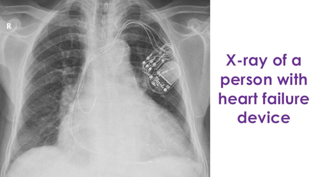 X-ray of a person with heart failure device