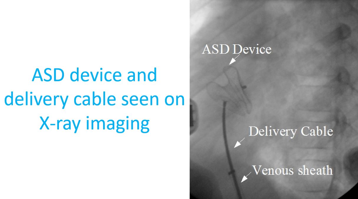 ASD device and delivery cable seen on X-ray imaging