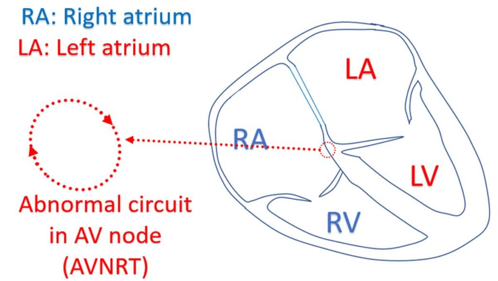 Abnormal circuit in AV node (AVNRT)