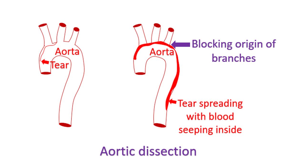 Aortic dissection blocking origin of branches