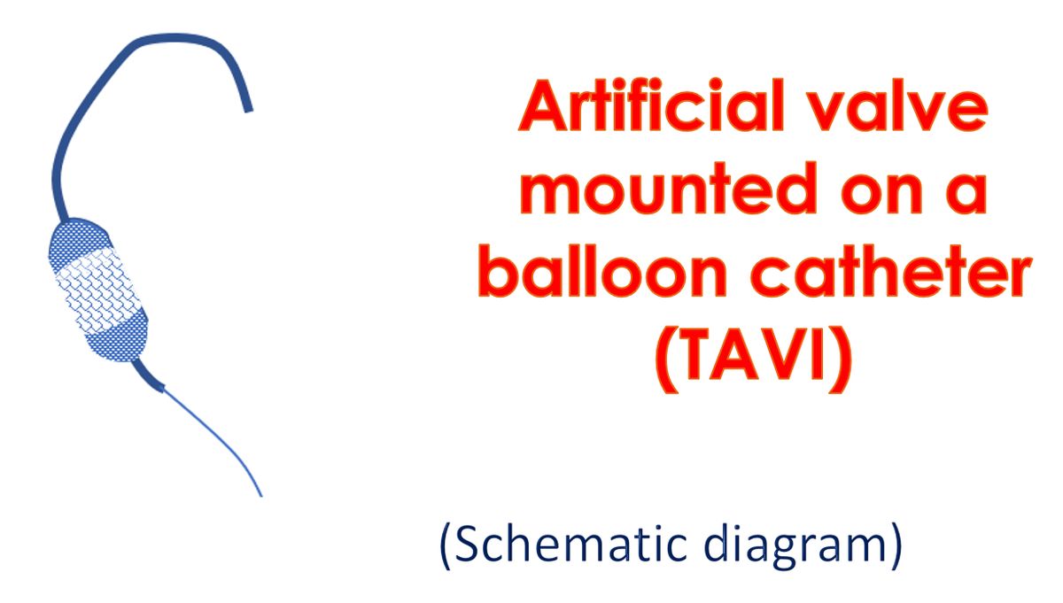 Artificial valve mounted on a balloon catheter (TAVI)