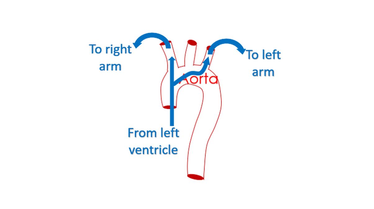 Basis of higher blood pressure in right arm