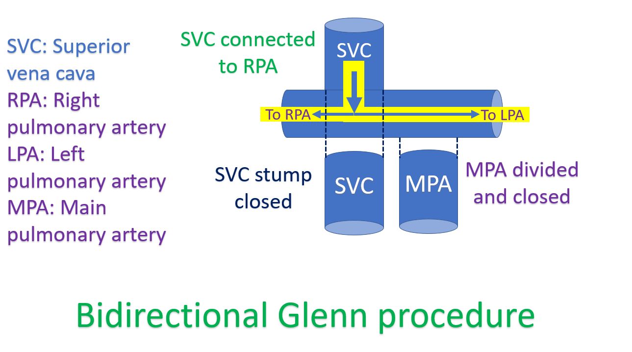 Bidirectional Glenn procedure