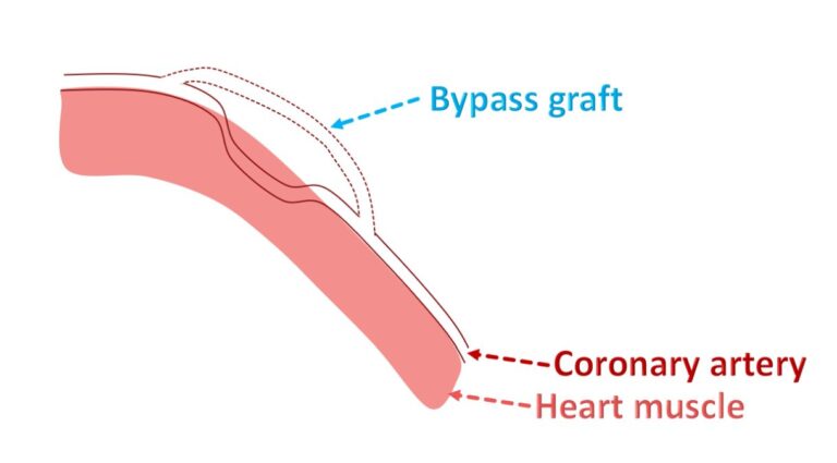 What is a myocardial bridge? – All About Heart And Blood Vessels