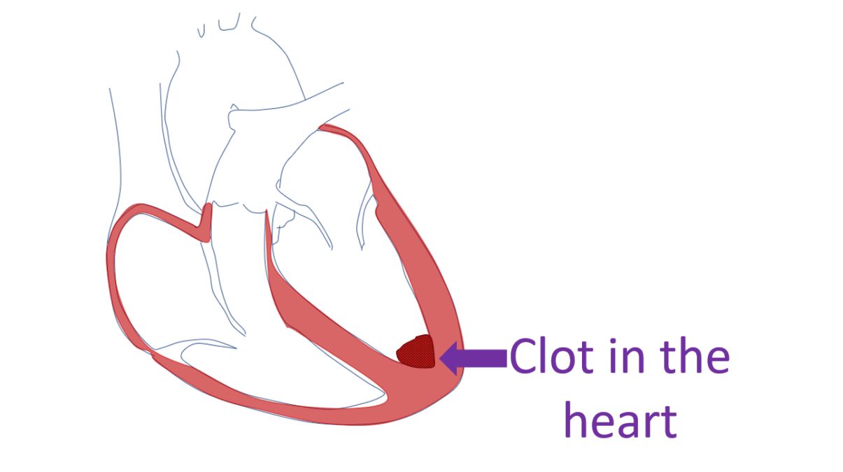 Clot in the heart in myocarditis