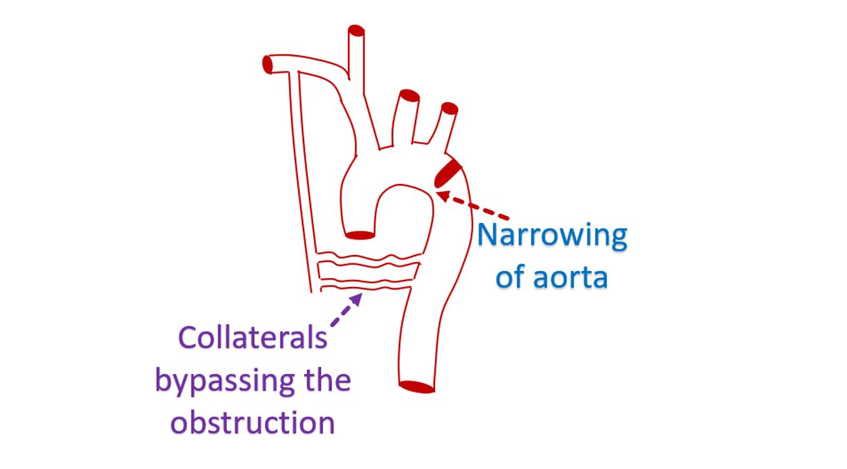 Collaterals bypassing the obstruction in coarctation of aorta