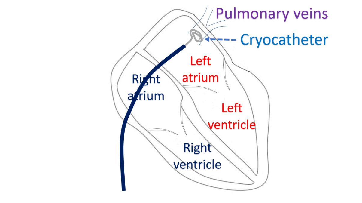 Cryocatheter for pulmonary vein ablation