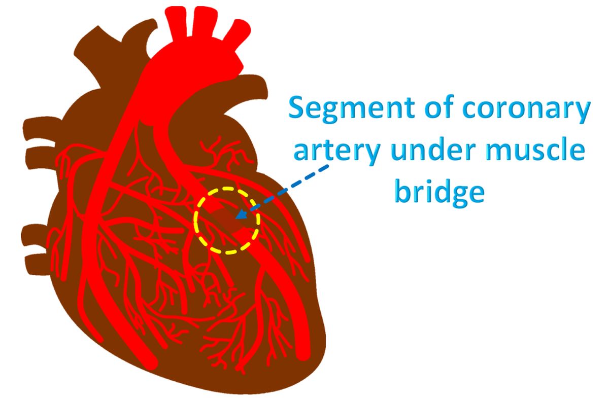 Diagram of myocardial bridge