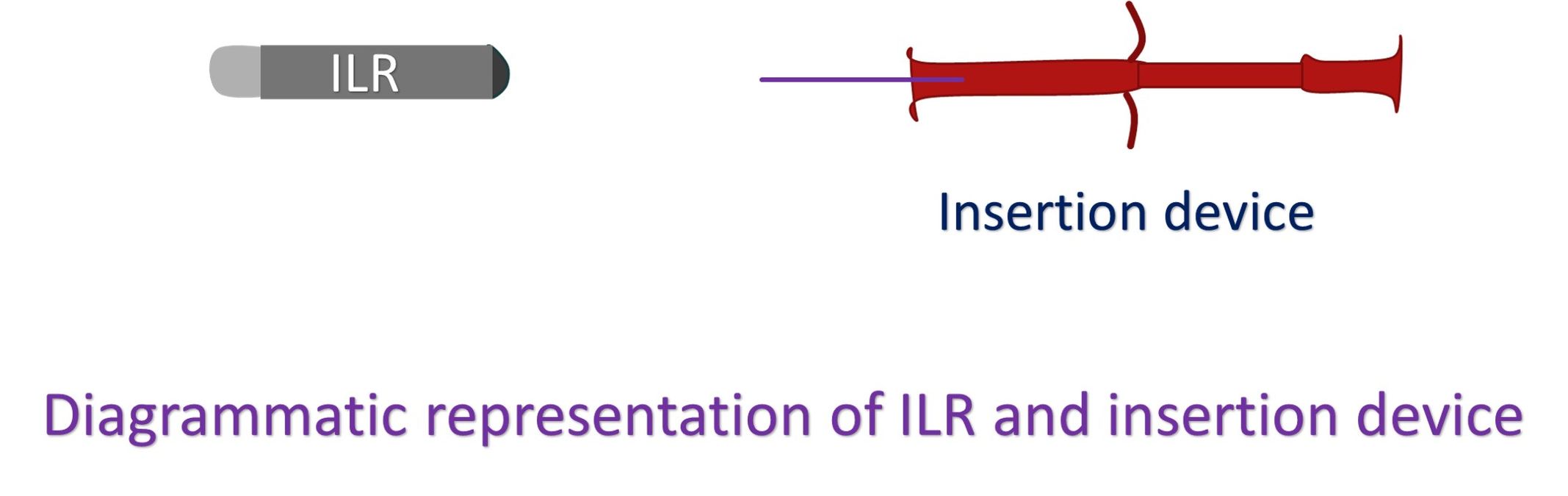 Diagrammatic representation of ILR and insertion device