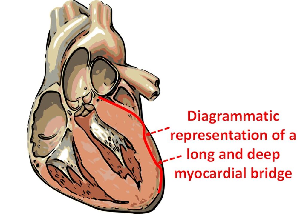 myocardial bridge literature review