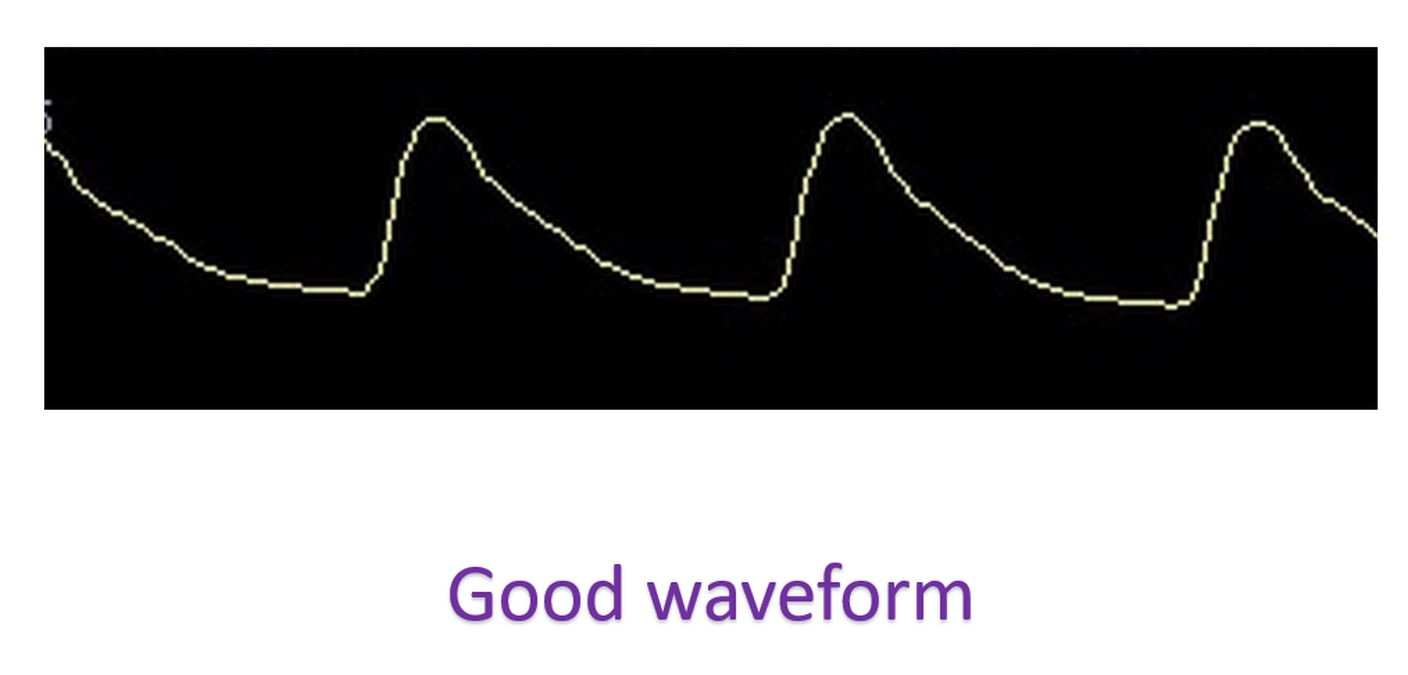 Good pulse oximetry waveform