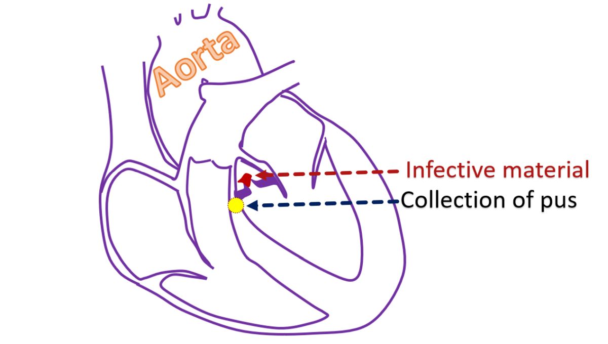 Infective material on aortic valve and nearby pus collection