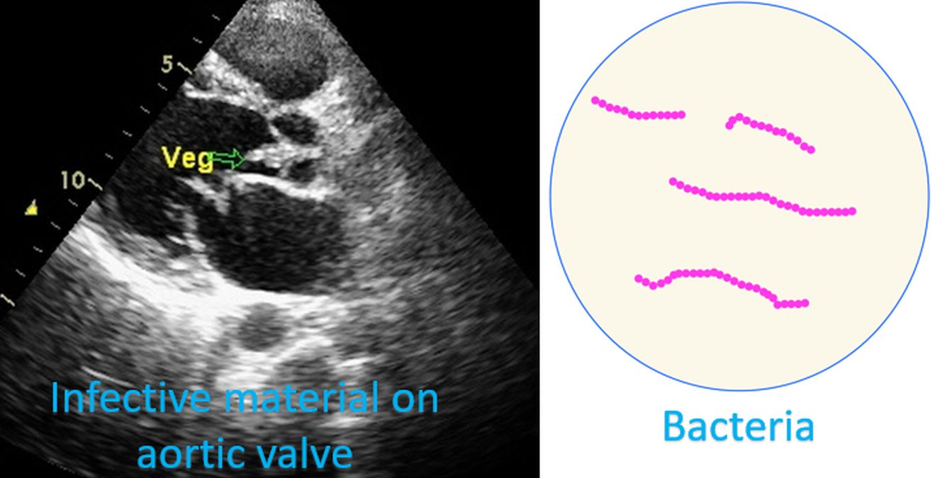 Infective material on aortic valve seen on echocardiogram and diagram of bacteria under the microscope