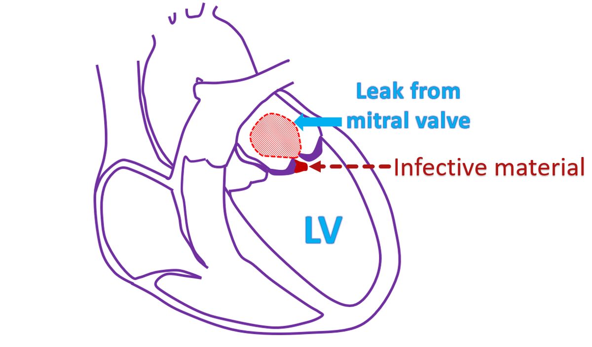 Infective material on leaky mitral valve