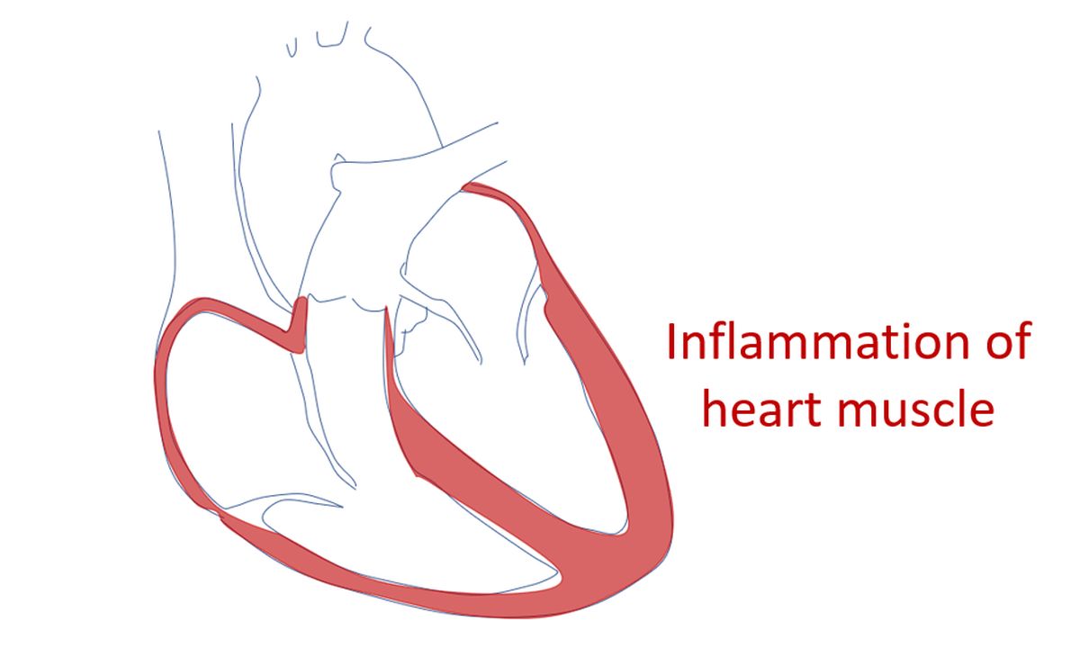 Inflammation of heart muscle (myocarditis)