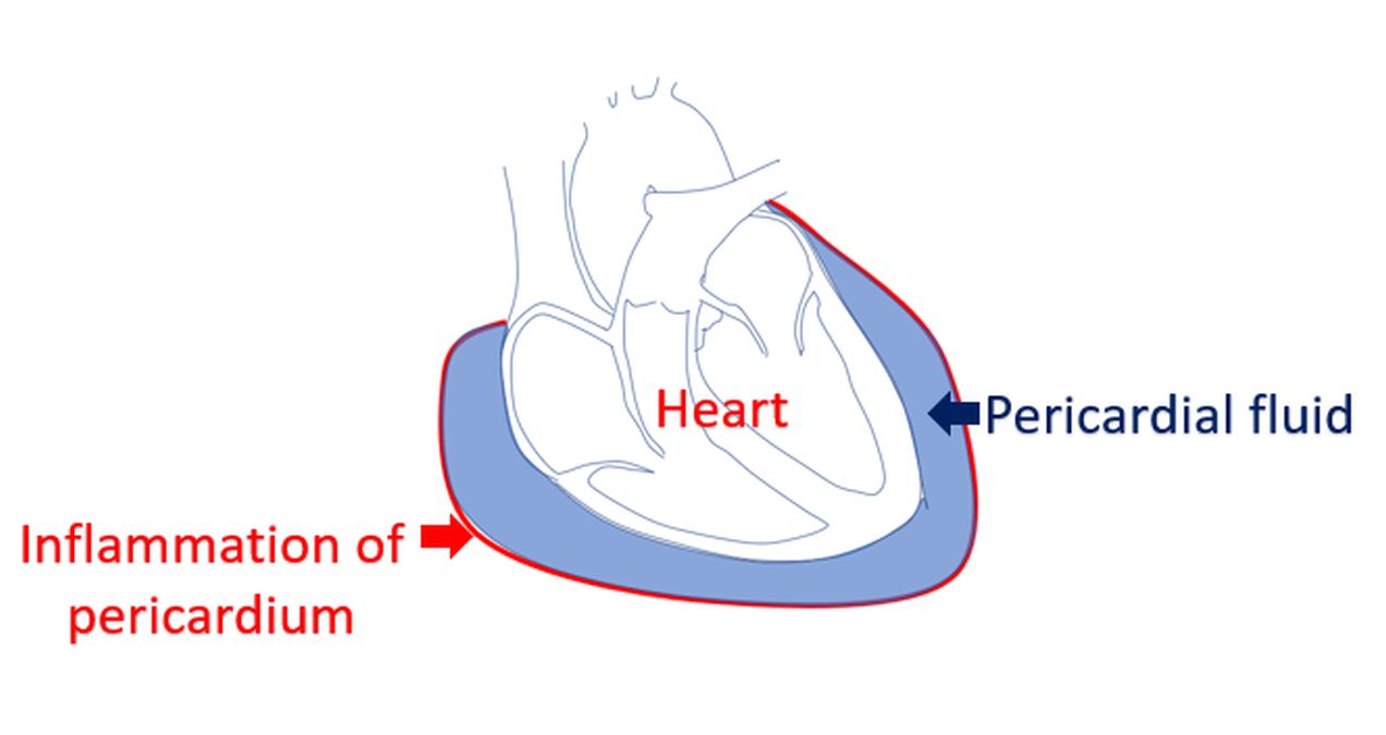Inflammation of pericardium with fluid collection (Pericarditis with pericardial effusion)