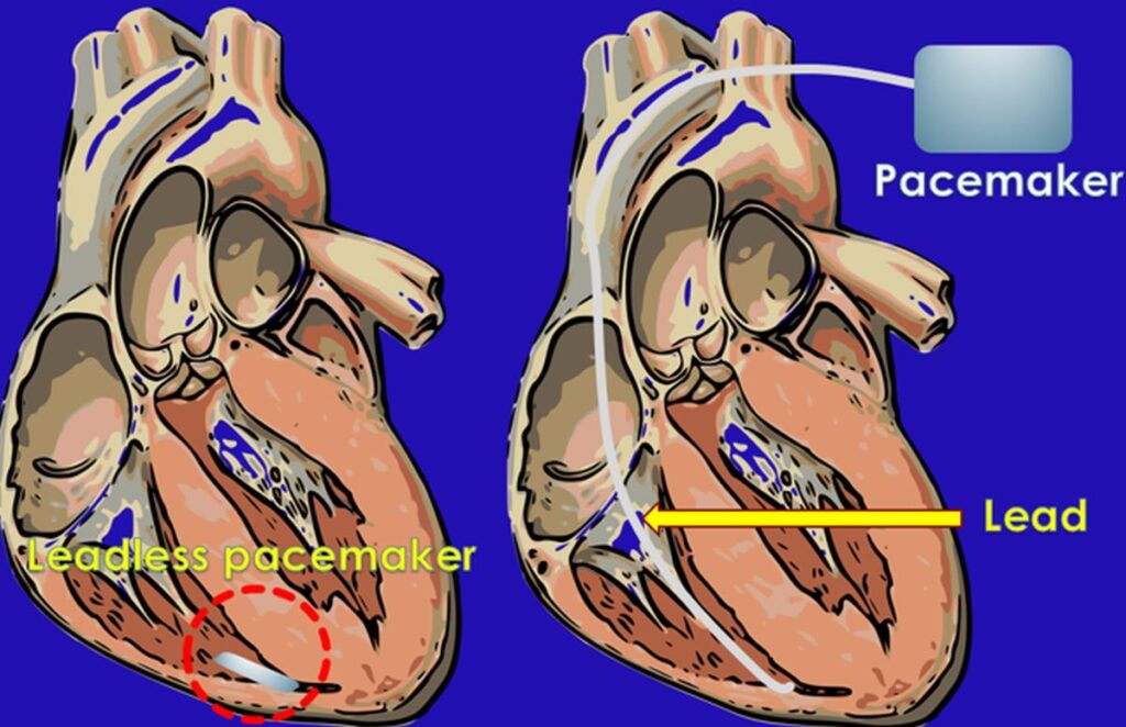 Leadless pacemaker vs pacemaker with a lead