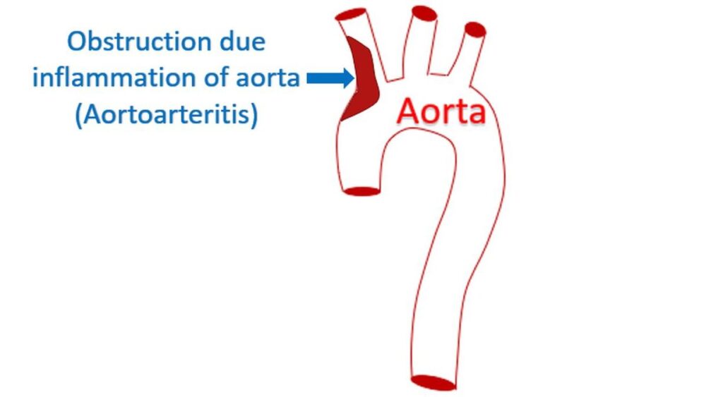 Obstruction due inflammation of aorta (Aortoarteritis)