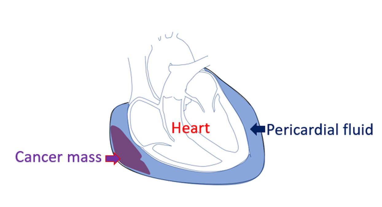 Pericardial effusion in cancer