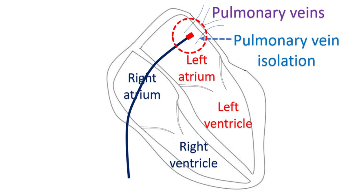 Pulmonary vein isolation for atrial fibrillation