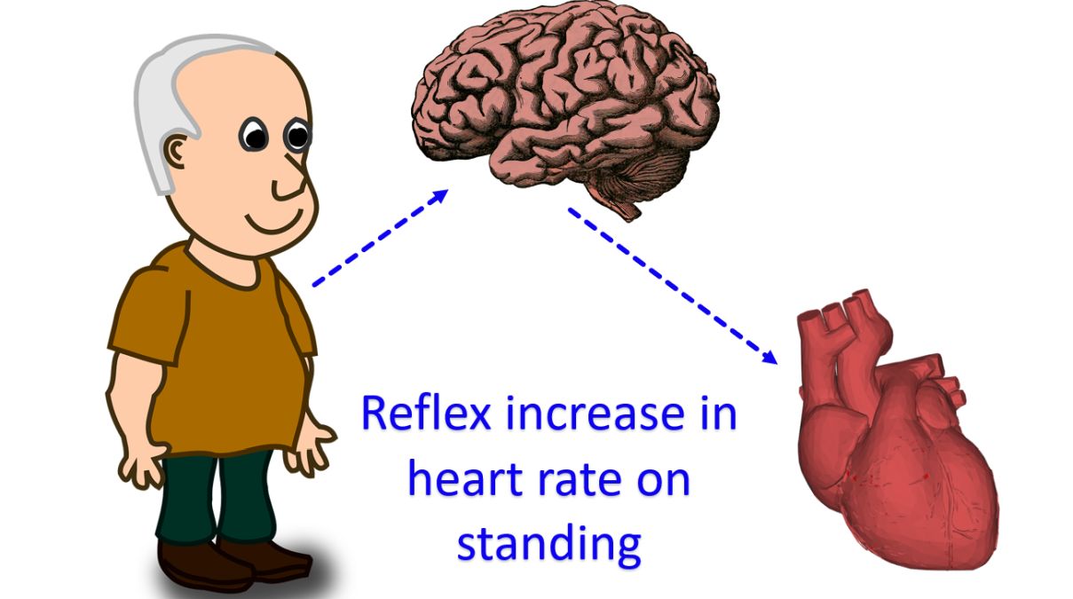 Reflex increase in heart rate on standing in POTS