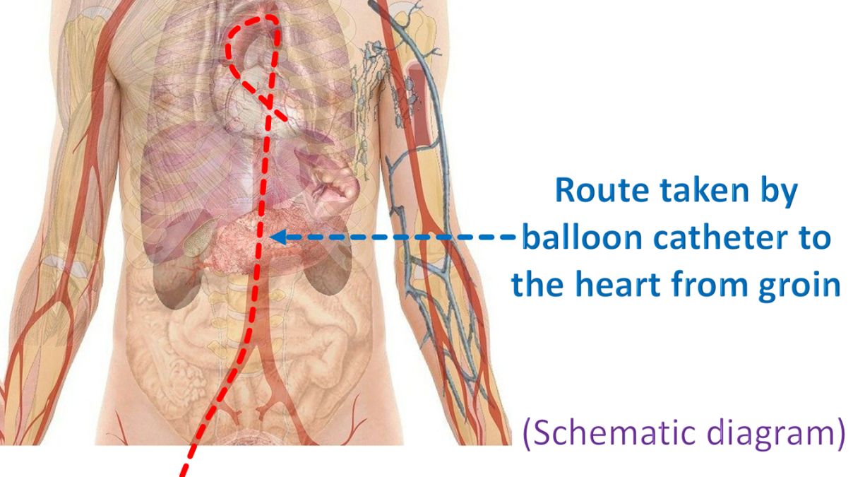 Route taken by balloon catheter to the heart from groin