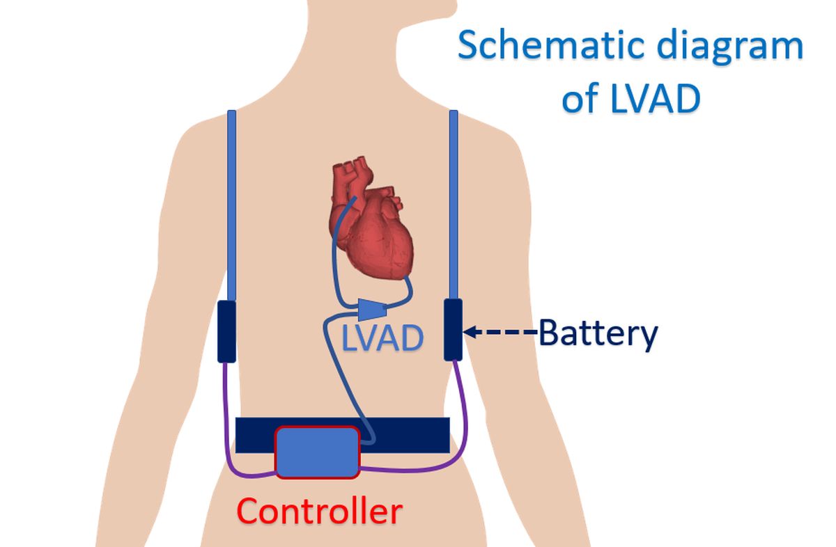 Schematic diagram of LVAD