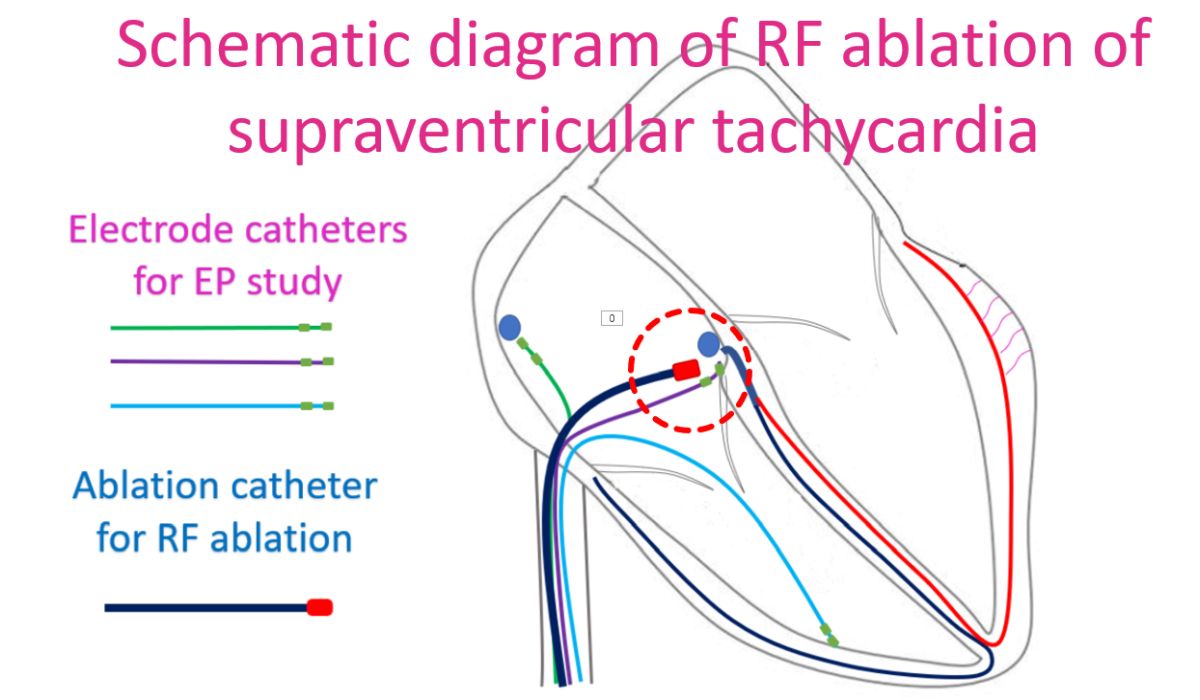 Schematic diagram of RF ablation of supraventricular tachycardia