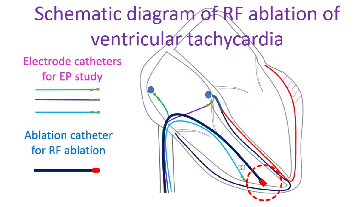 Schematic diagram of RF ablation of ventricular tachycardia