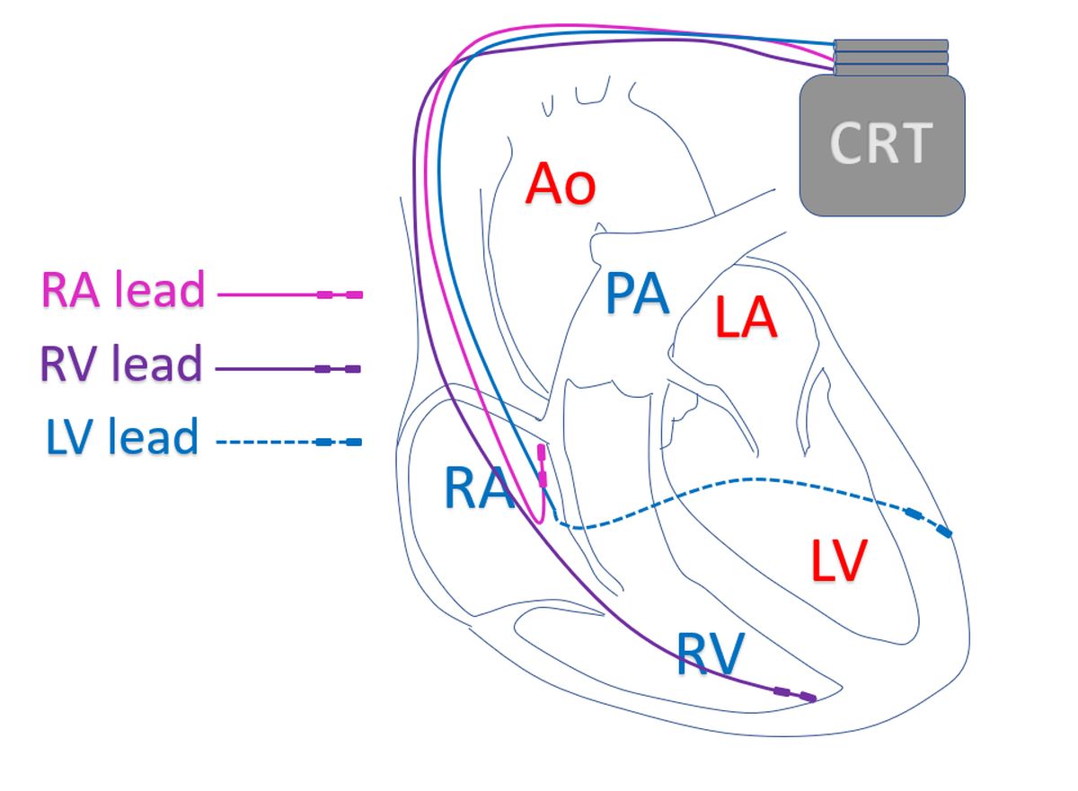 Schematic diagram of cardiac resynchronization therapy device with leads