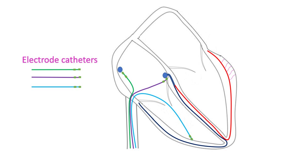 Schematic diagram of electrode catheters used for EP study (only two electrodes shown on each catheter)