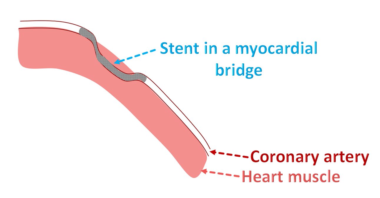 Stent in a myocardial bridge