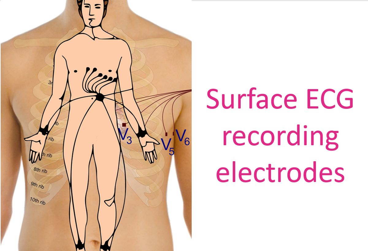Surface ECG recording electrodes